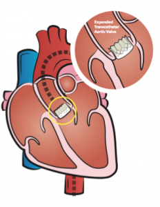 TAVR - Arkansas Heart Hospital