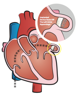 Watchman Device - Arkansas Heart Hospital