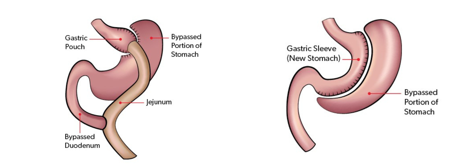 Bariatric Surgery What Are My Options? Arkansas Heart Hospital